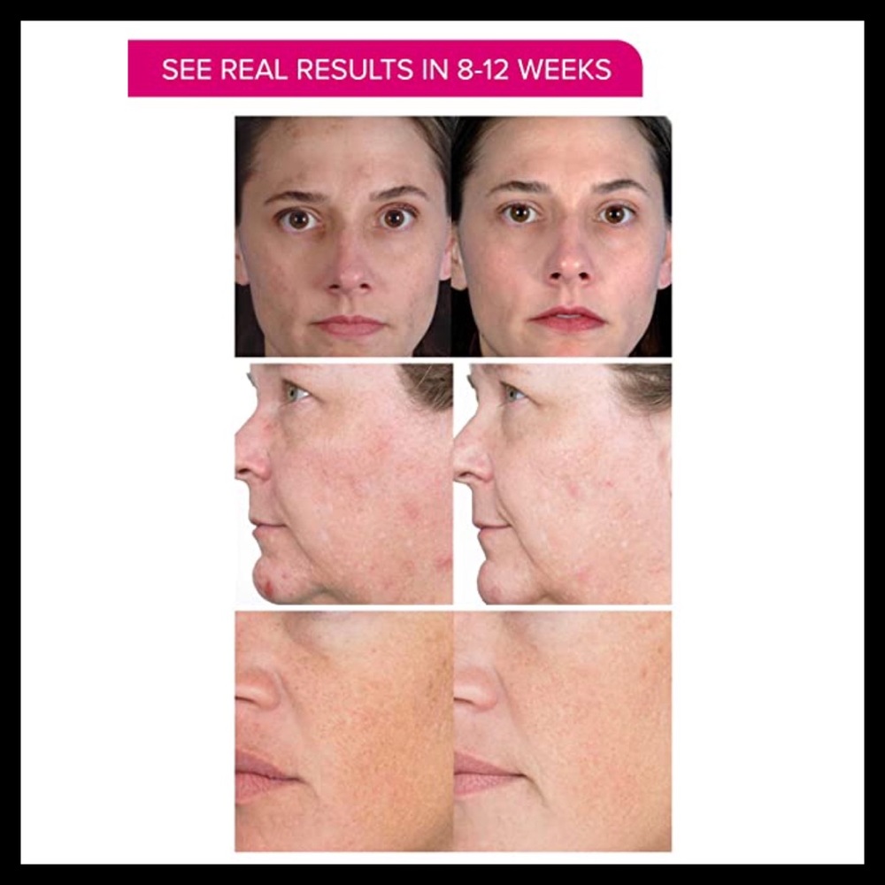 PMD Personal Microderm Skin Renewal System - Picture 4 of 8